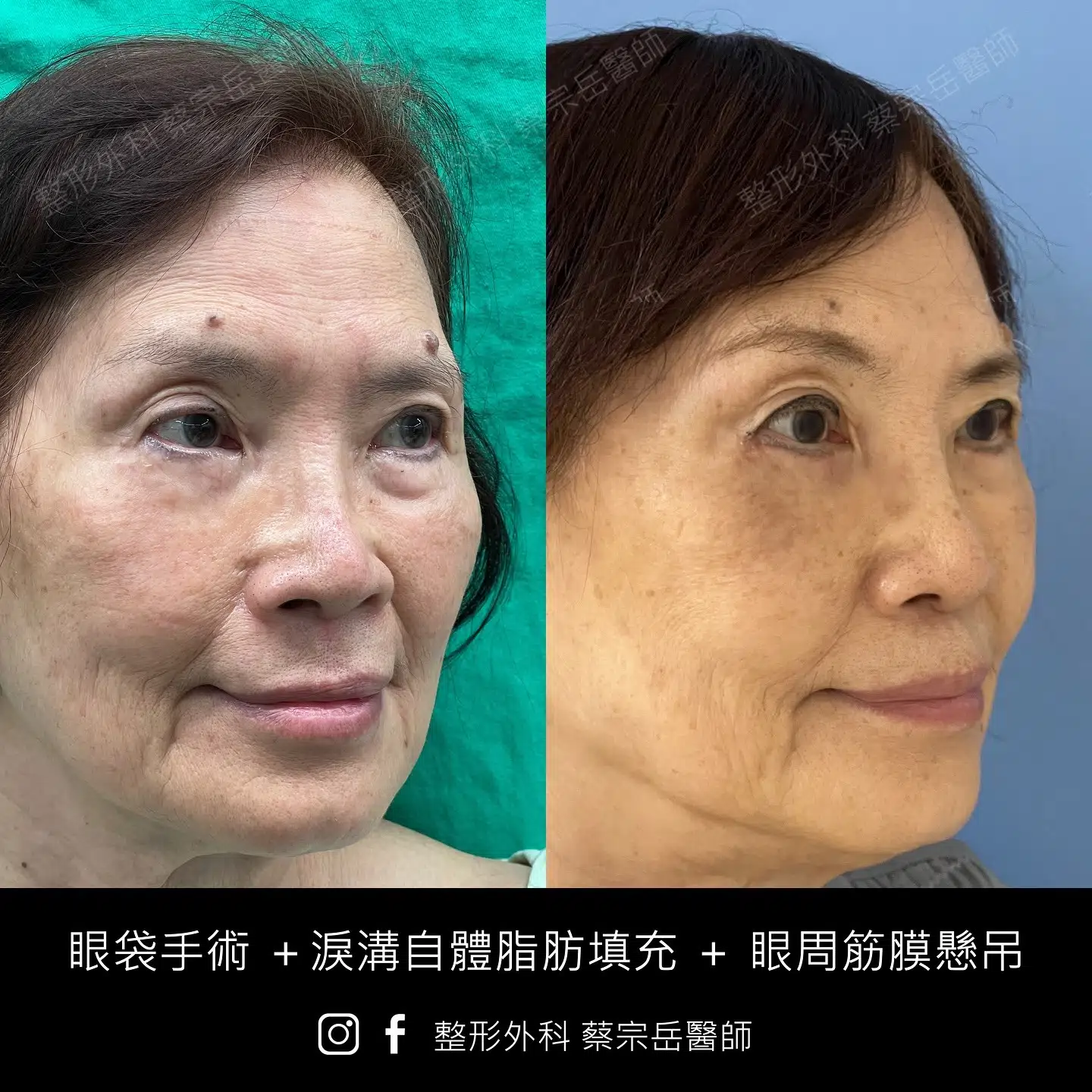 眼袋手術+淚溝自體脂肪填充+眼周筋膜懸吊