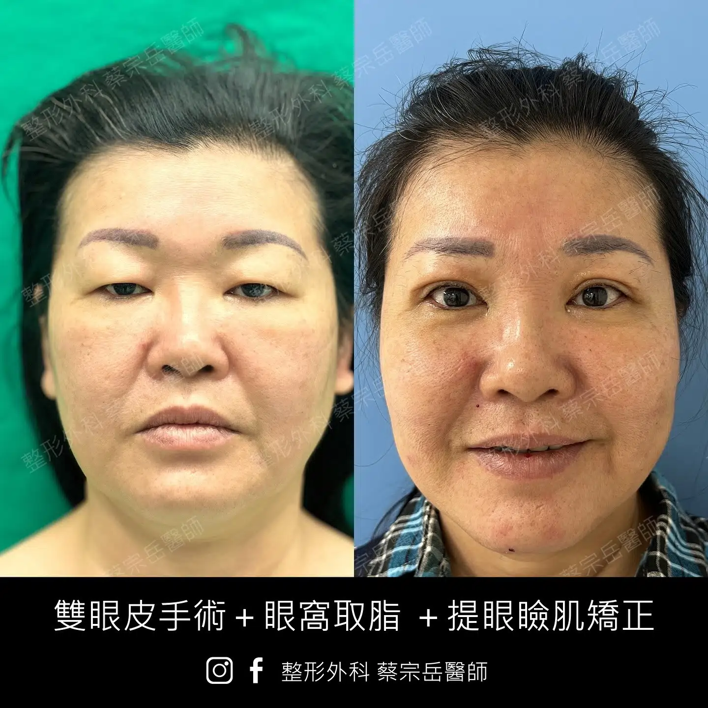 雙眼皮手術+眼窩取脂+提眼瞼肌矯正