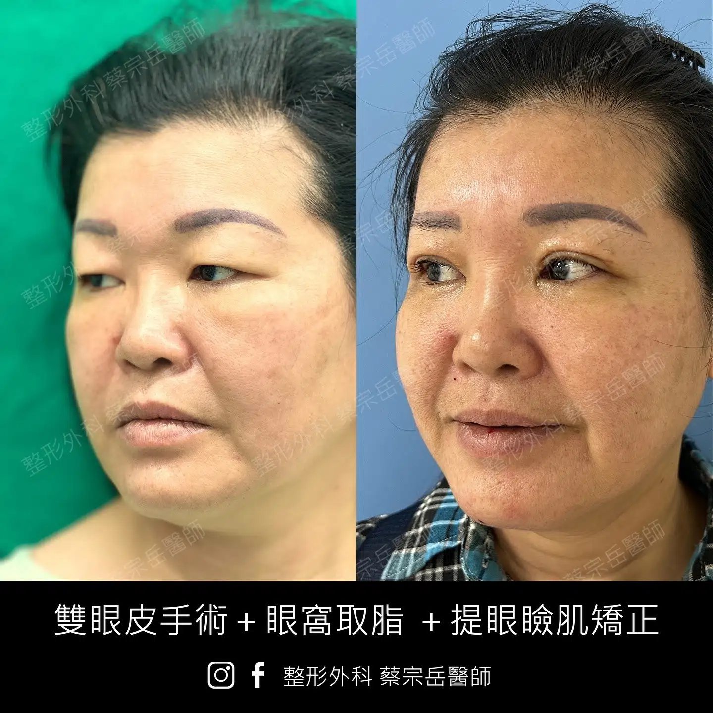 雙眼皮手術+眼窩取脂+提眼瞼肌矯正