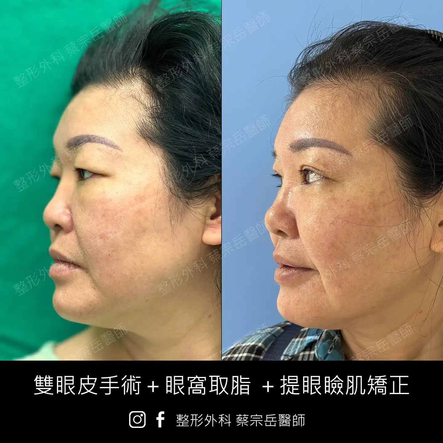 雙眼皮手術+眼窩取脂+提眼瞼肌矯正