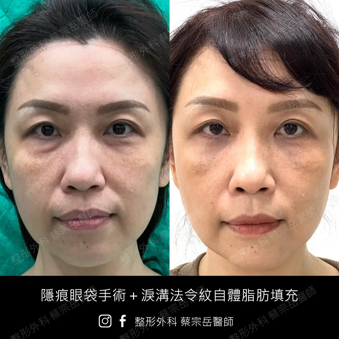 隱痕眼袋手術+淚溝法令紋自體脂肪填充