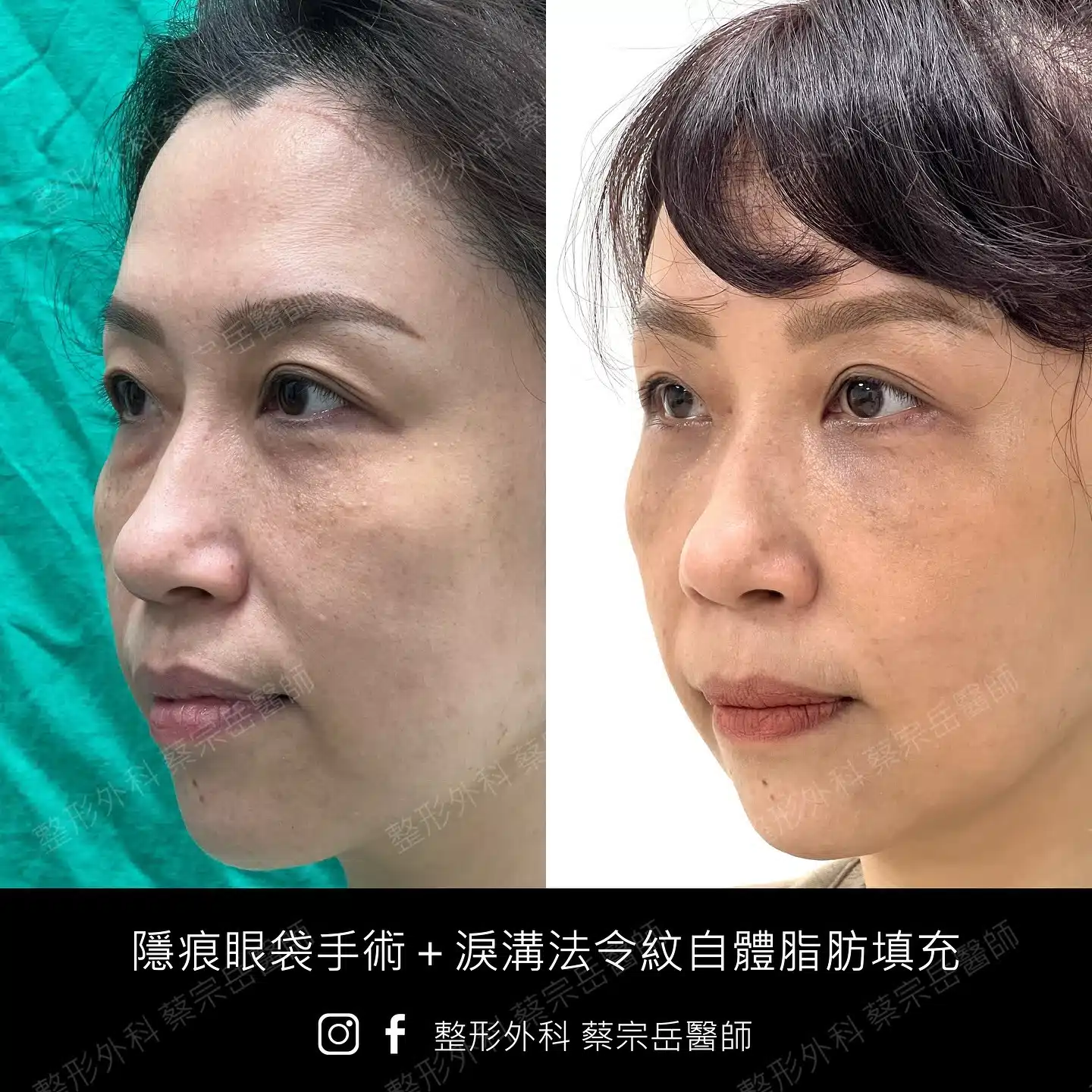 隱痕眼袋手術+淚溝法令紋自體脂肪填充