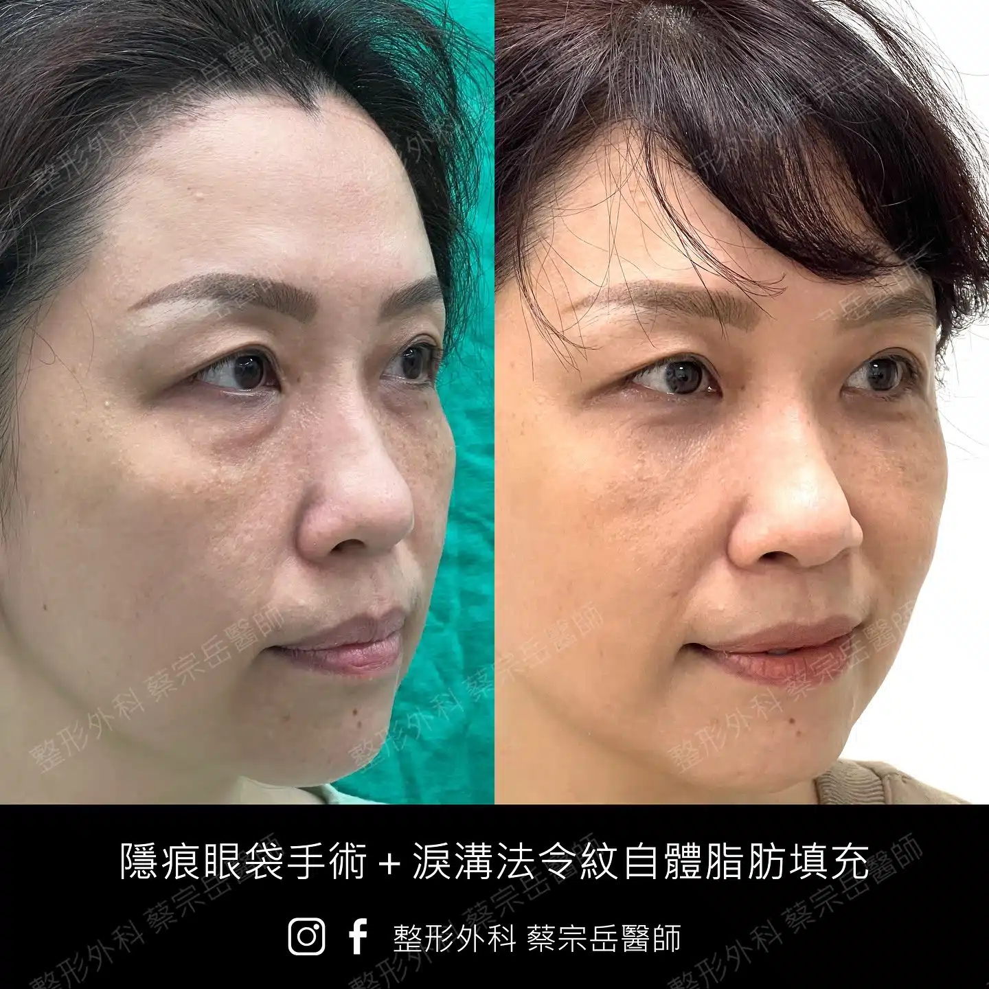 隱痕眼袋手術+淚溝法令紋自體脂肪填充