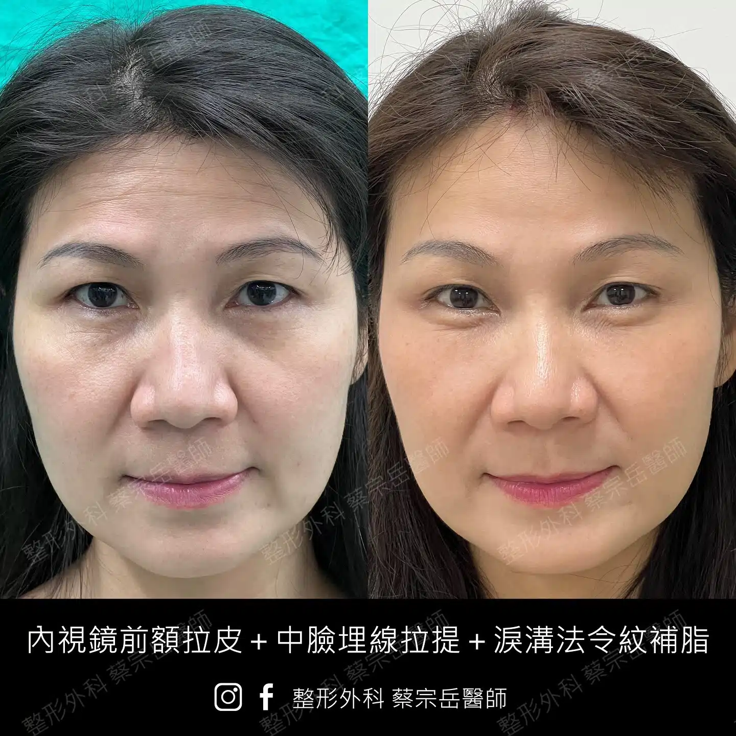 內視鏡前額拉皮+中臉埋線拉提+淚溝法令紋補脂