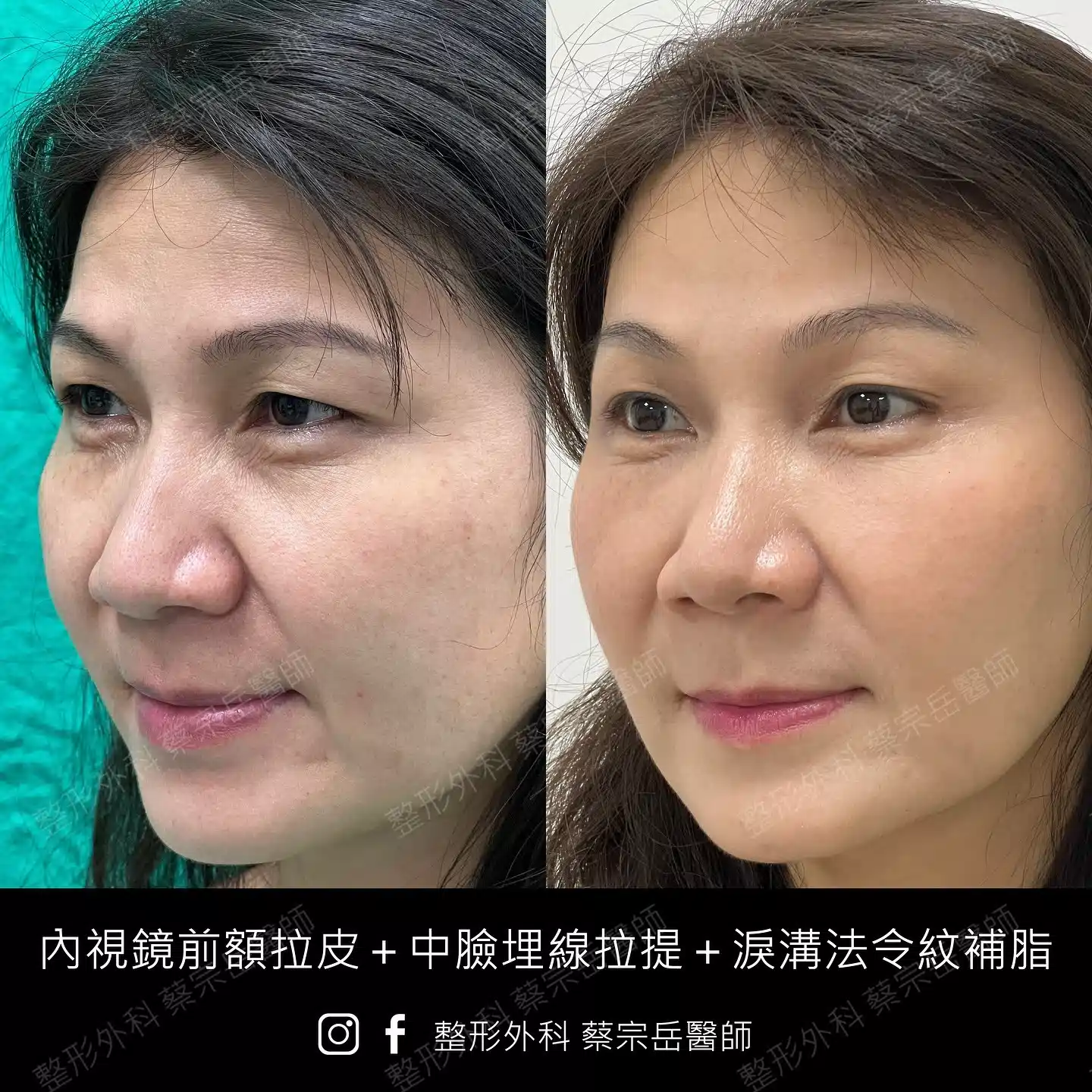 內視鏡前額拉皮+中臉埋線拉提+淚溝法令紋補脂