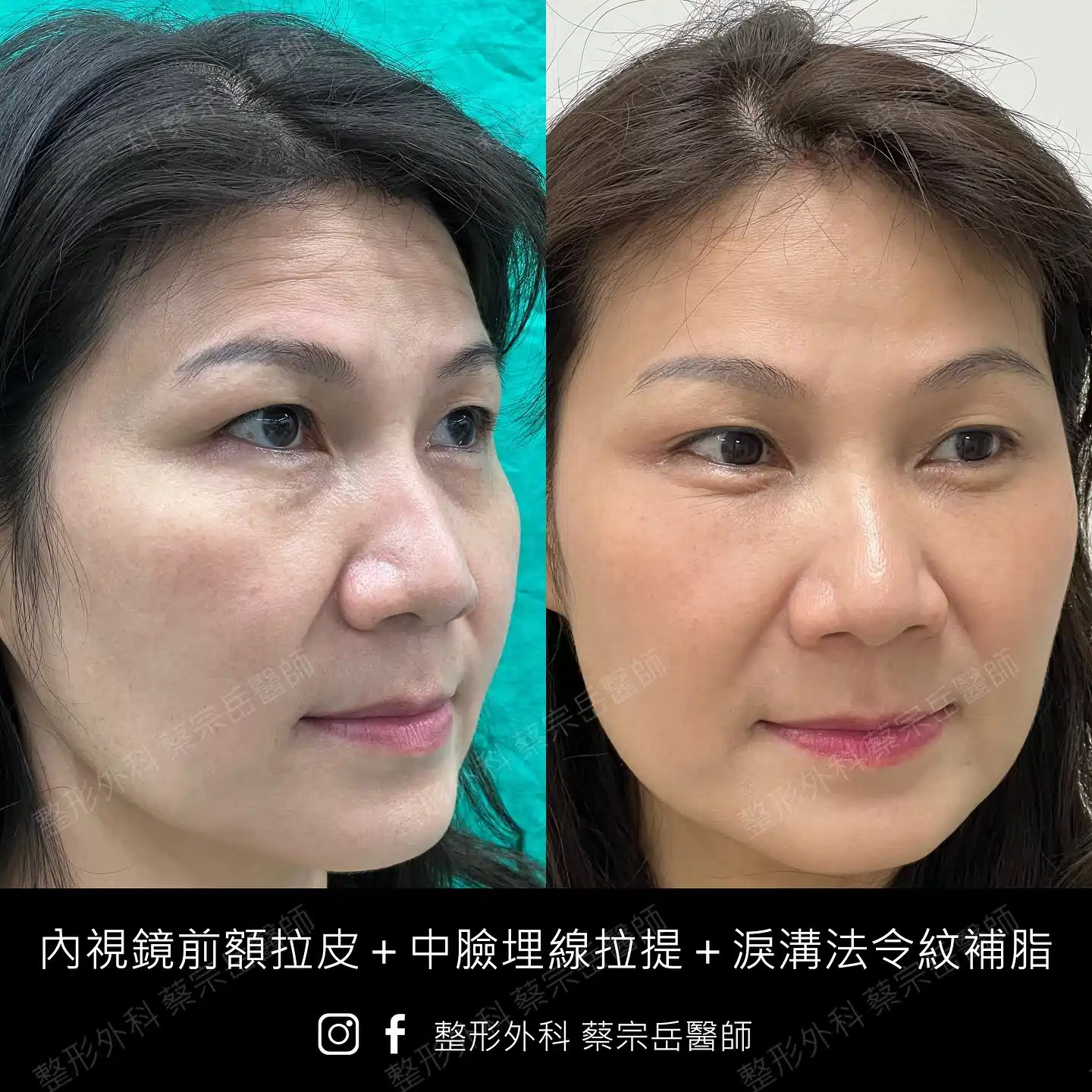 內視鏡前額拉皮+中臉埋線拉提+淚溝法令紋補脂