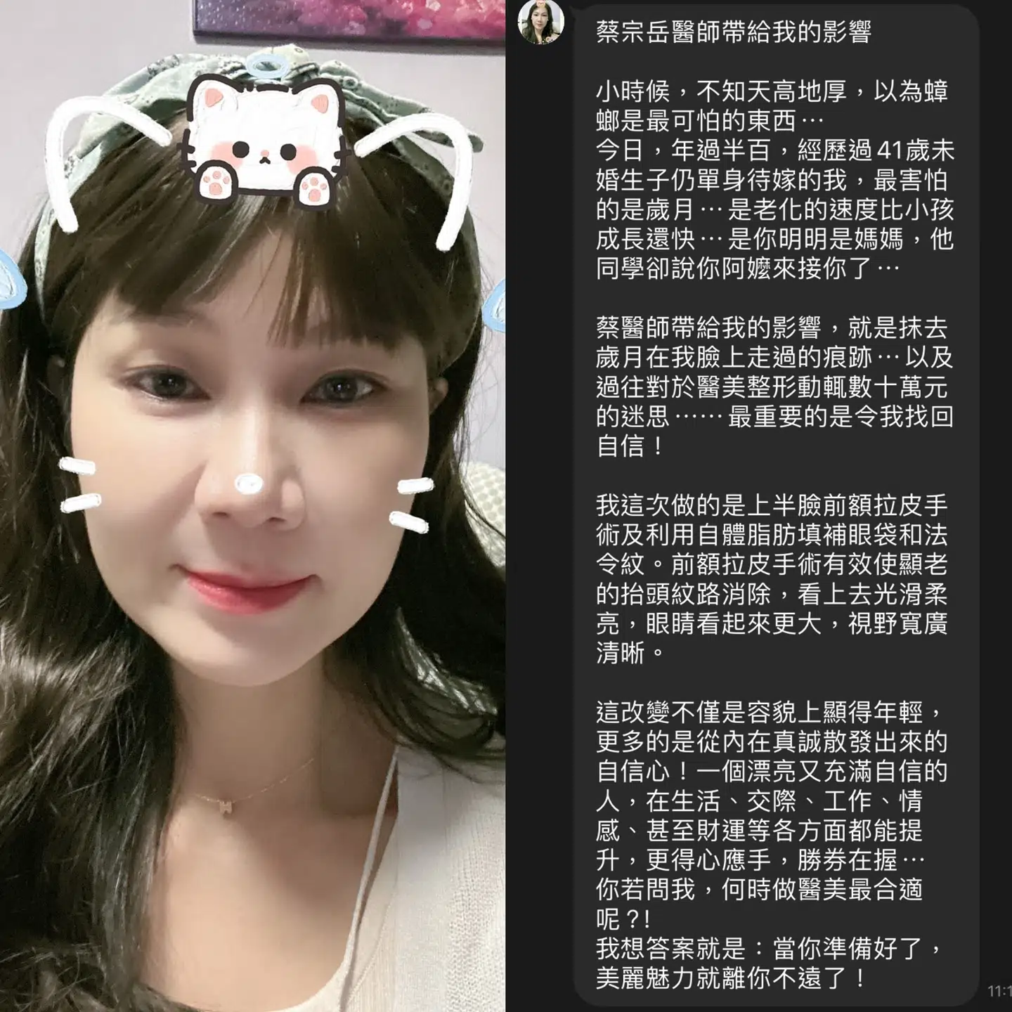 內視鏡前額拉皮+中臉埋線拉提+淚溝法令紋補脂