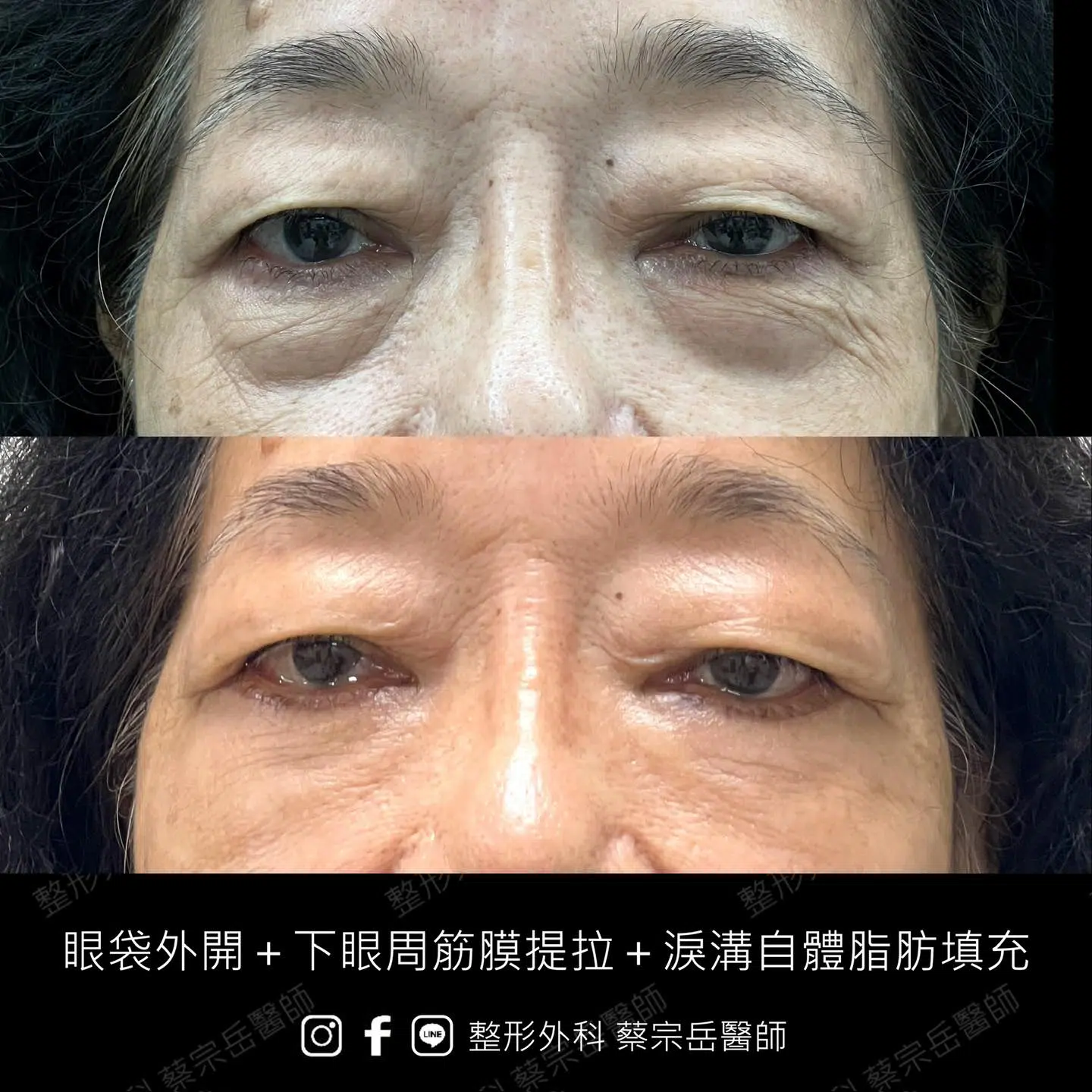 眼袋手術+下眼周筋膜提拉+淚溝自體脂肪填充