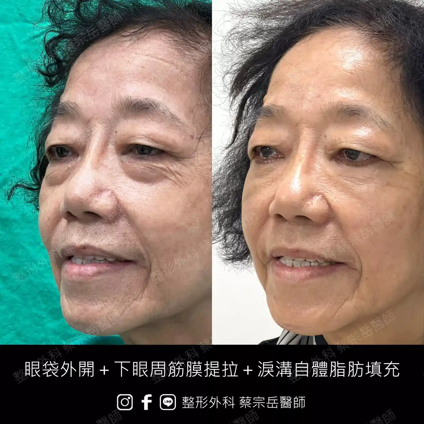 眼袋手術+下眼周筋膜提拉+淚溝自體脂肪填充