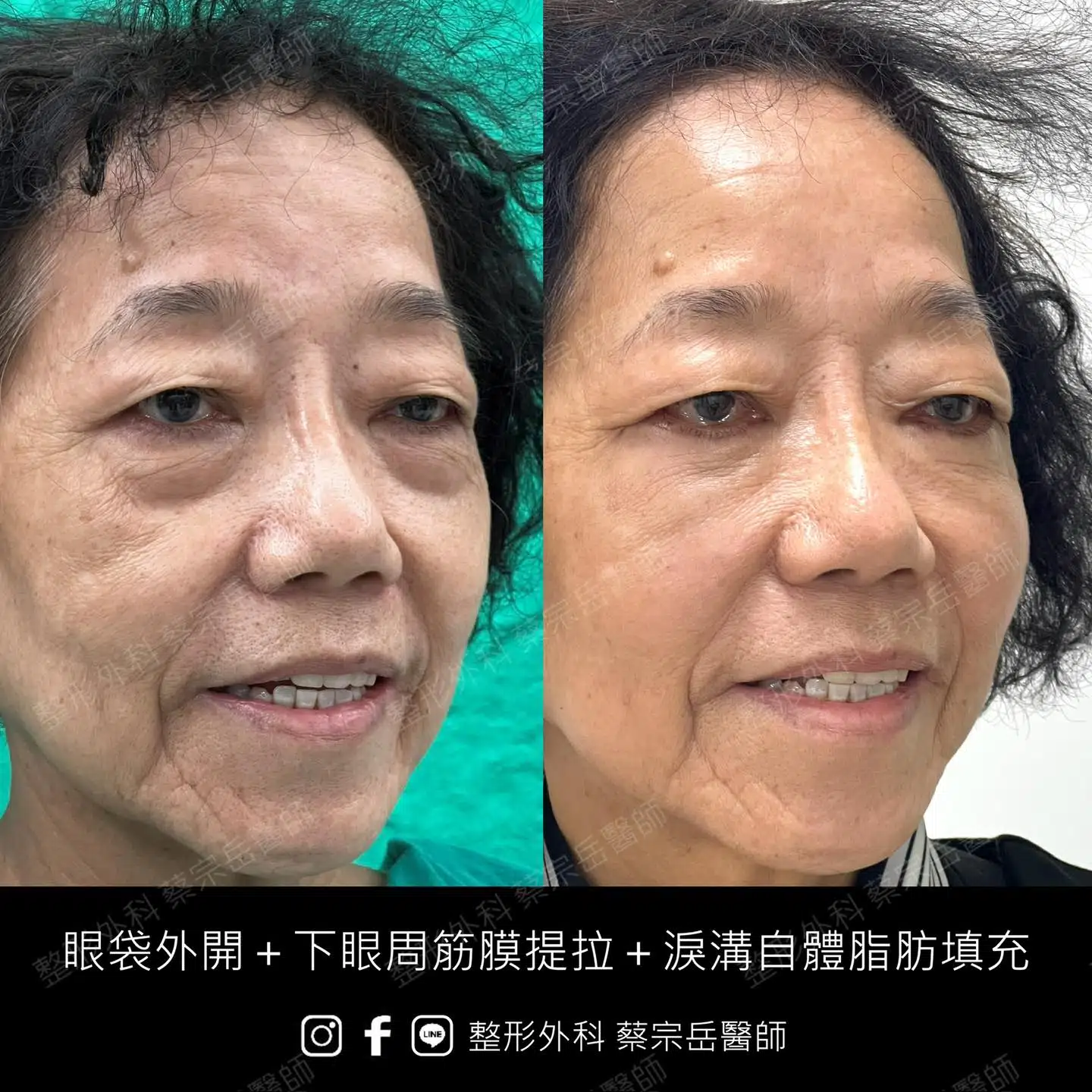 眼袋手術+下眼周筋膜提拉+淚溝自體脂肪填充