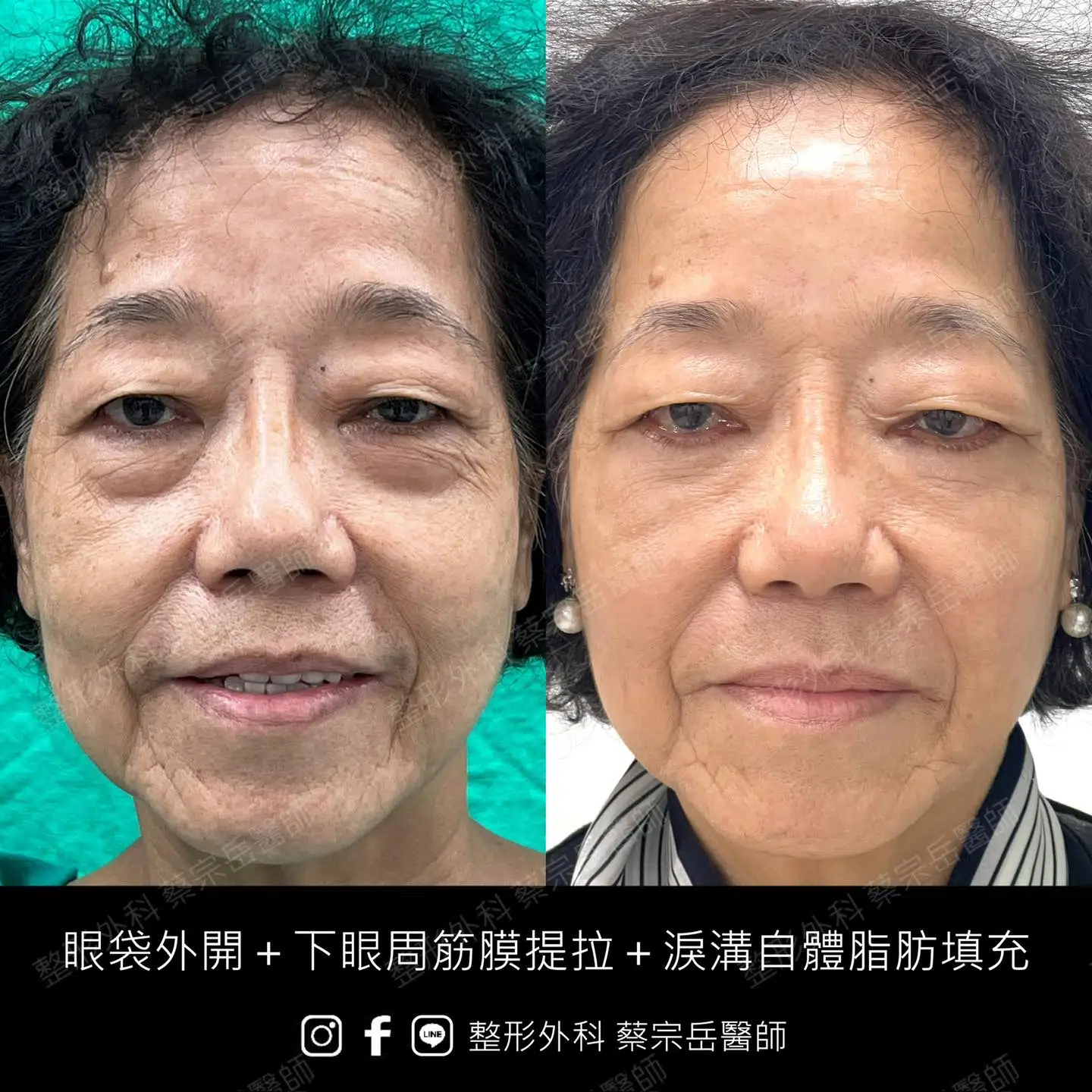 眼袋手術+下眼周筋膜提拉+淚溝自體脂肪填充