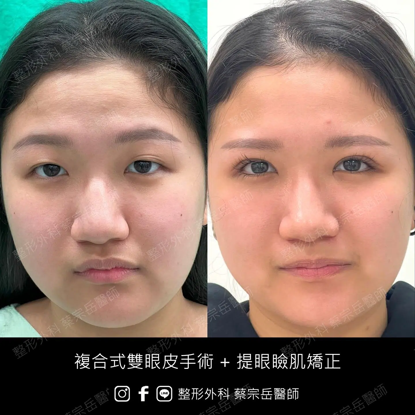 複合式雙眼皮手術+提眼瞼肌矯正