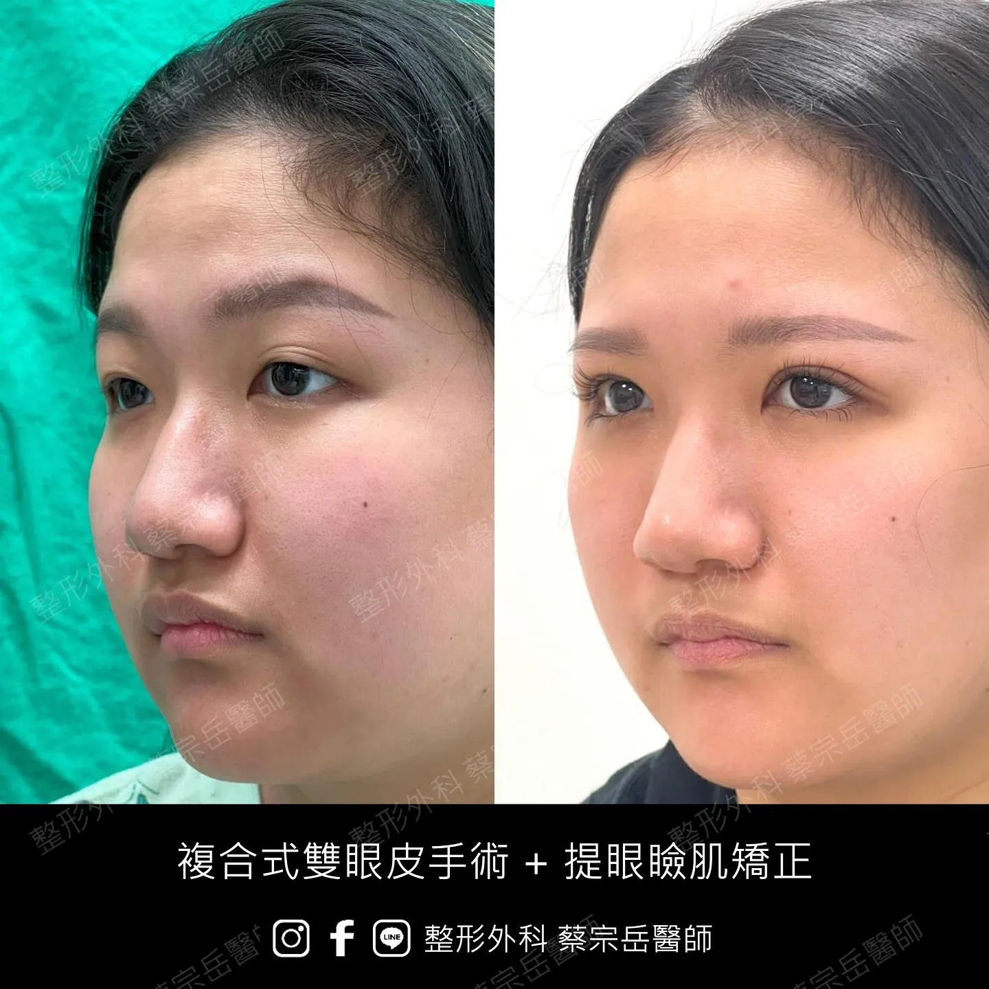 複合式雙眼皮手術+提眼瞼肌矯正