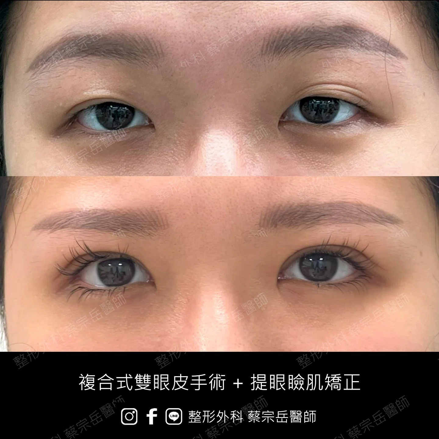 複合式雙眼皮手術+提眼瞼肌矯正