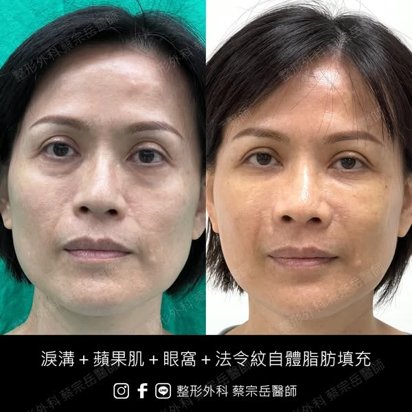 淚溝+蘋果肌+眼窩+法令紋自體脂肪填充