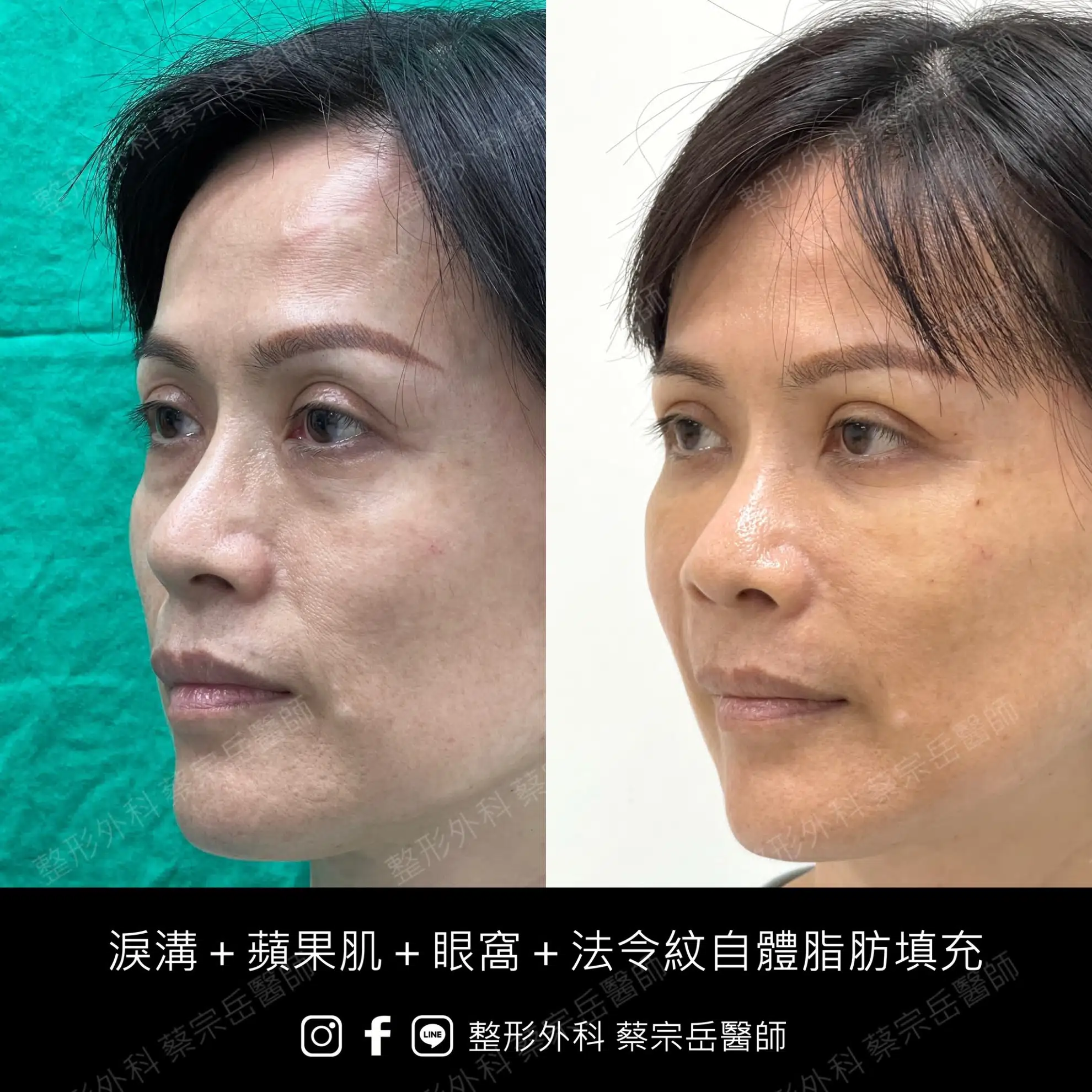 淚溝+蘋果肌+眼窩+法令紋自體脂肪填充