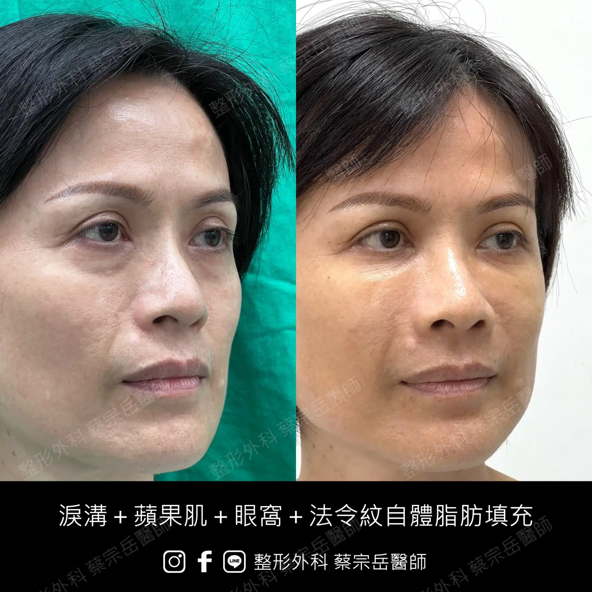 淚溝+蘋果肌+眼窩+法令紋自體脂肪填充