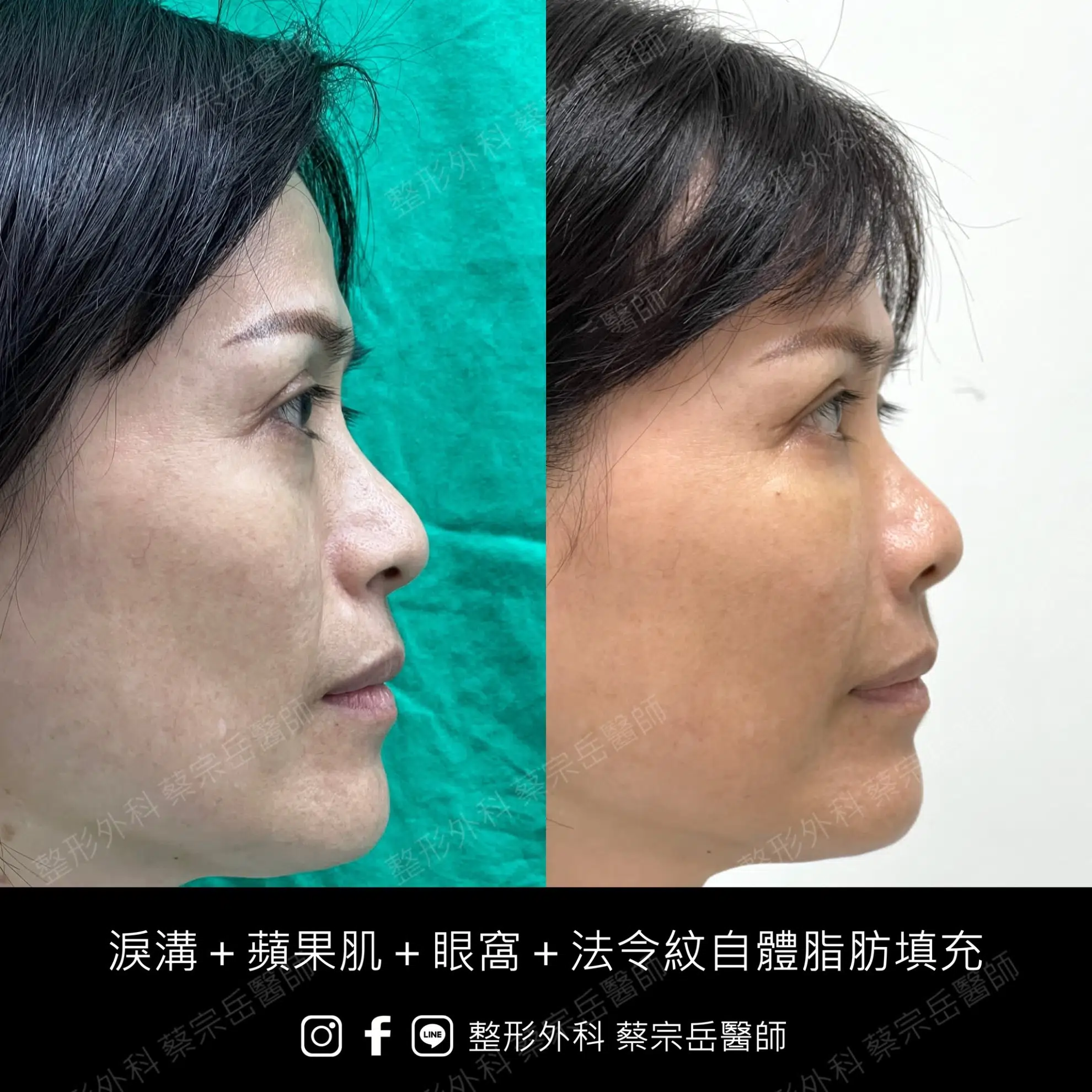 淚溝+蘋果肌+眼窩+法令紋自體脂肪填充