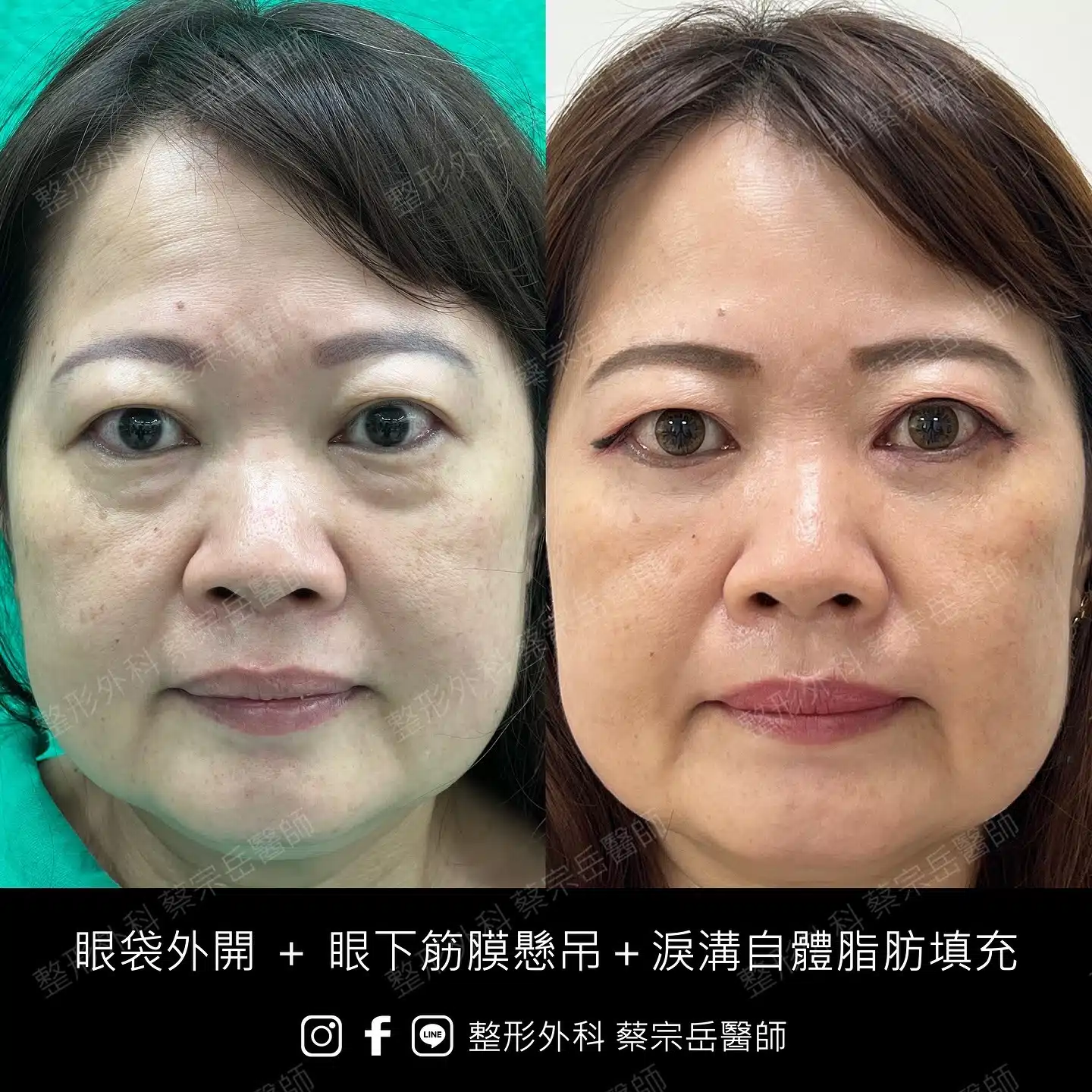 眼袋外開+眼下筋膜懸吊+淚溝自體脂肪填充