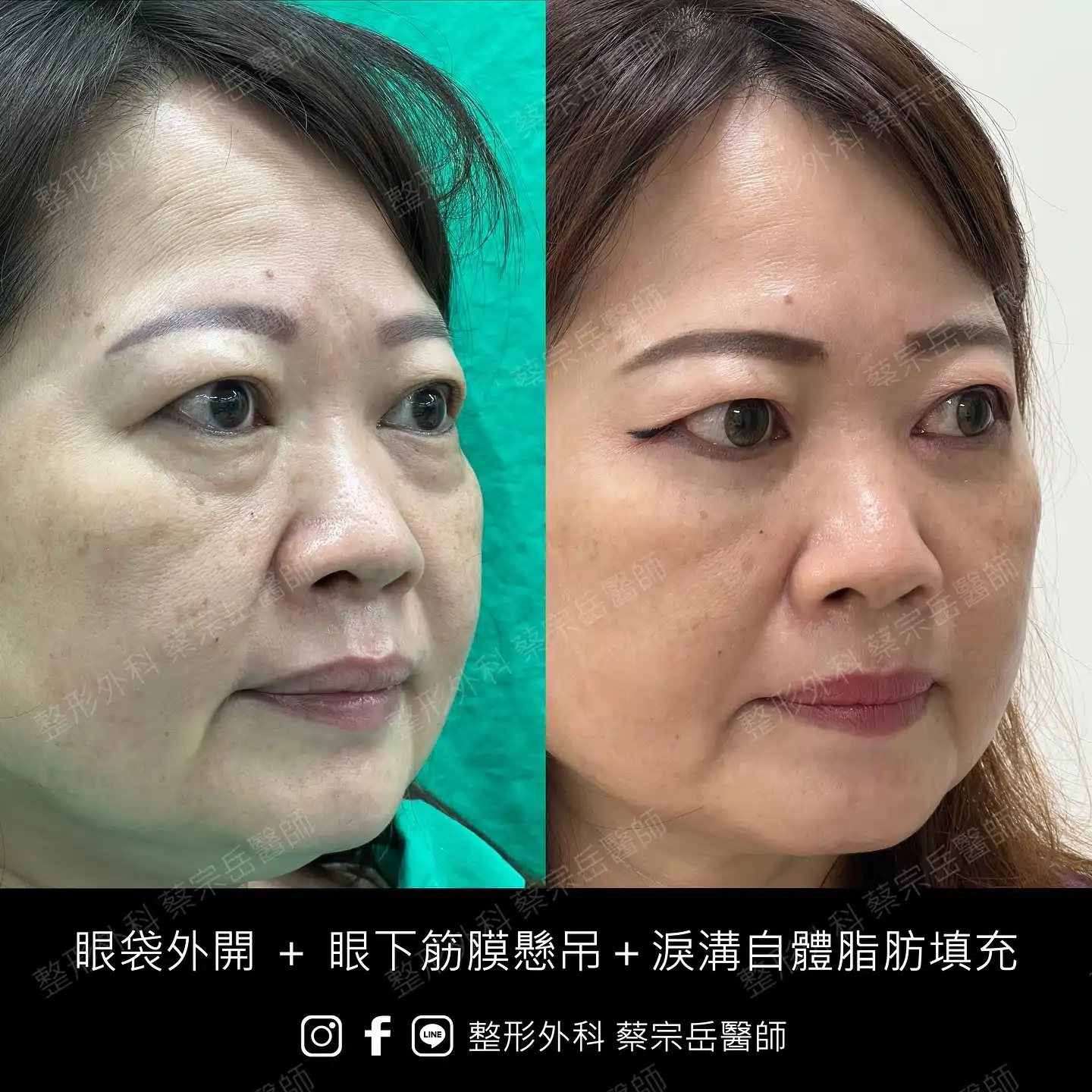 眼袋外開+眼下筋膜懸吊+淚溝自體脂肪填充