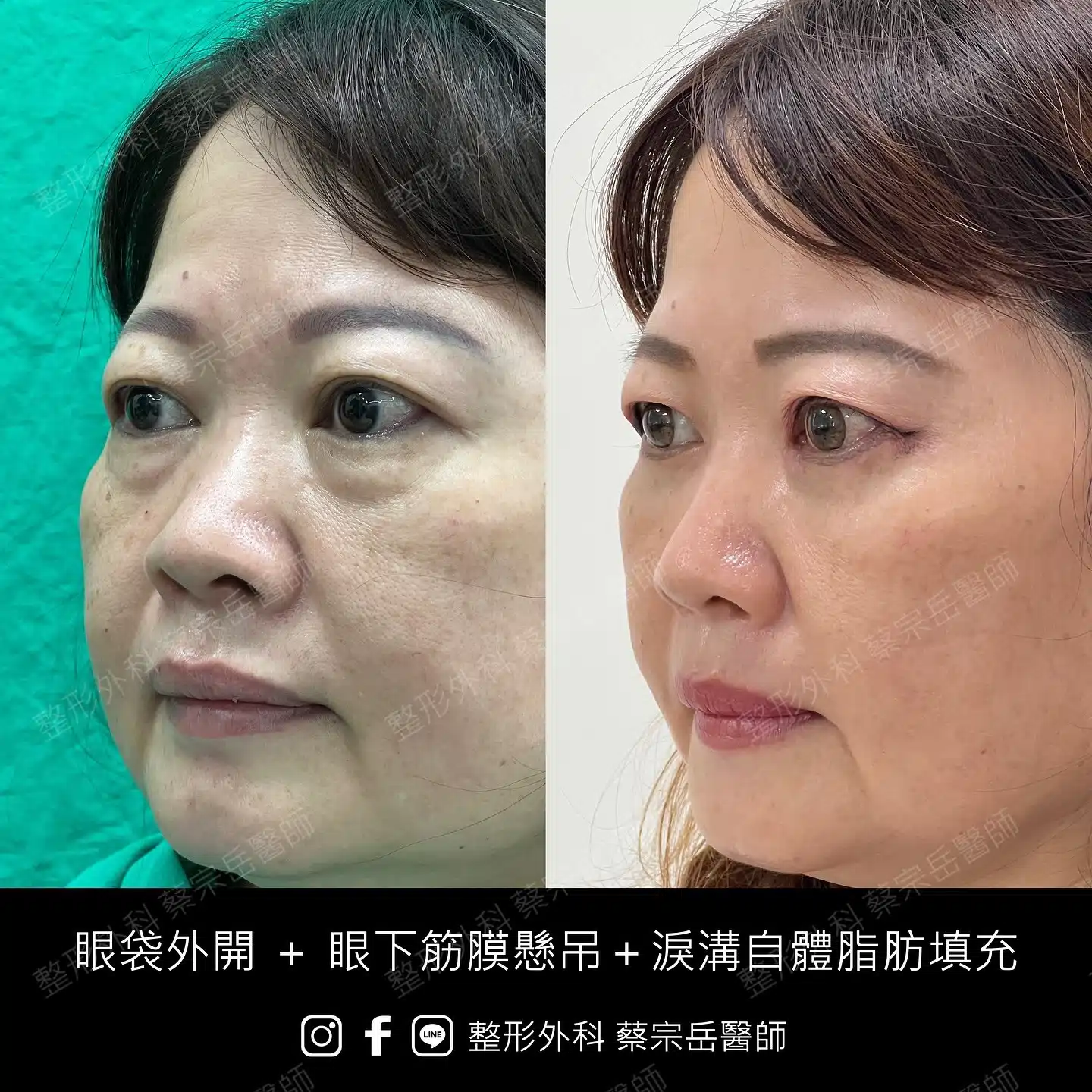 眼袋外開+眼下筋膜懸吊+淚溝自體脂肪填充