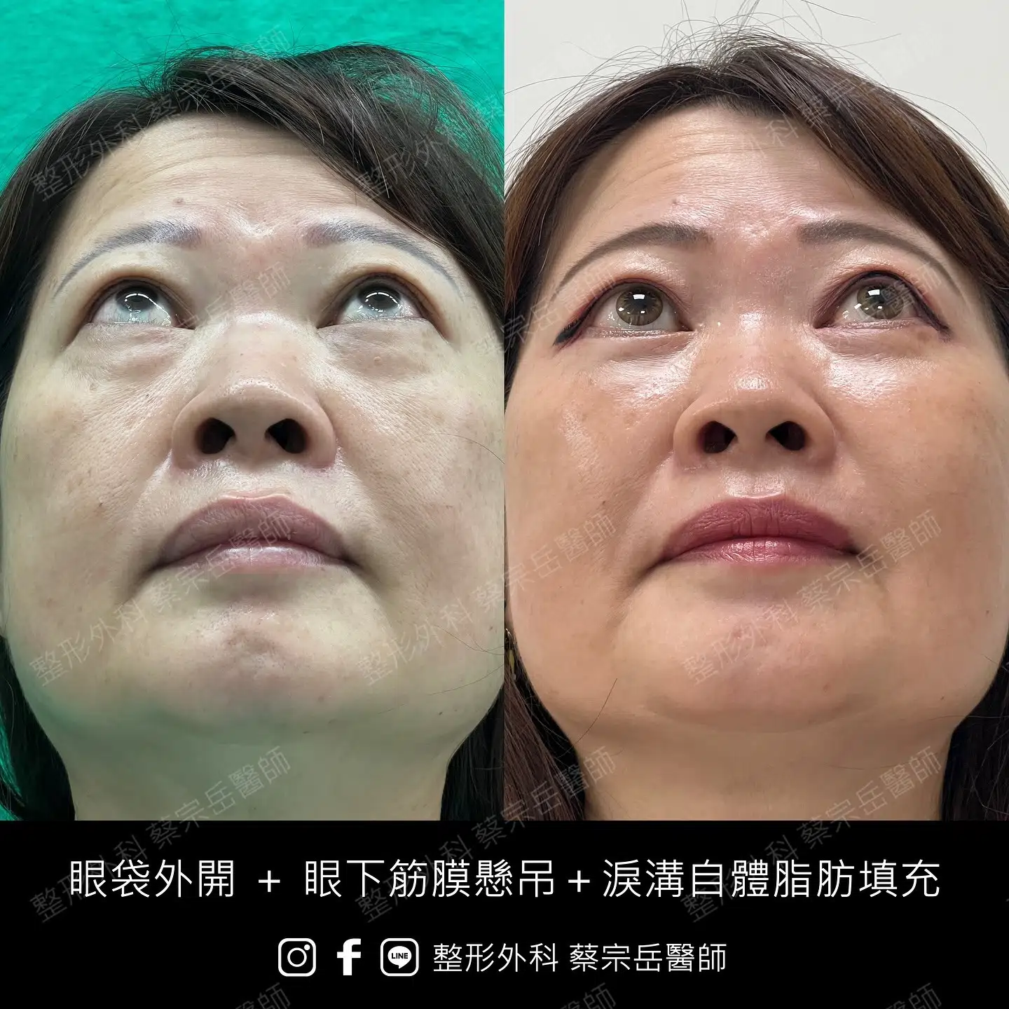 眼袋外開+眼下筋膜懸吊+淚溝自體脂肪填充