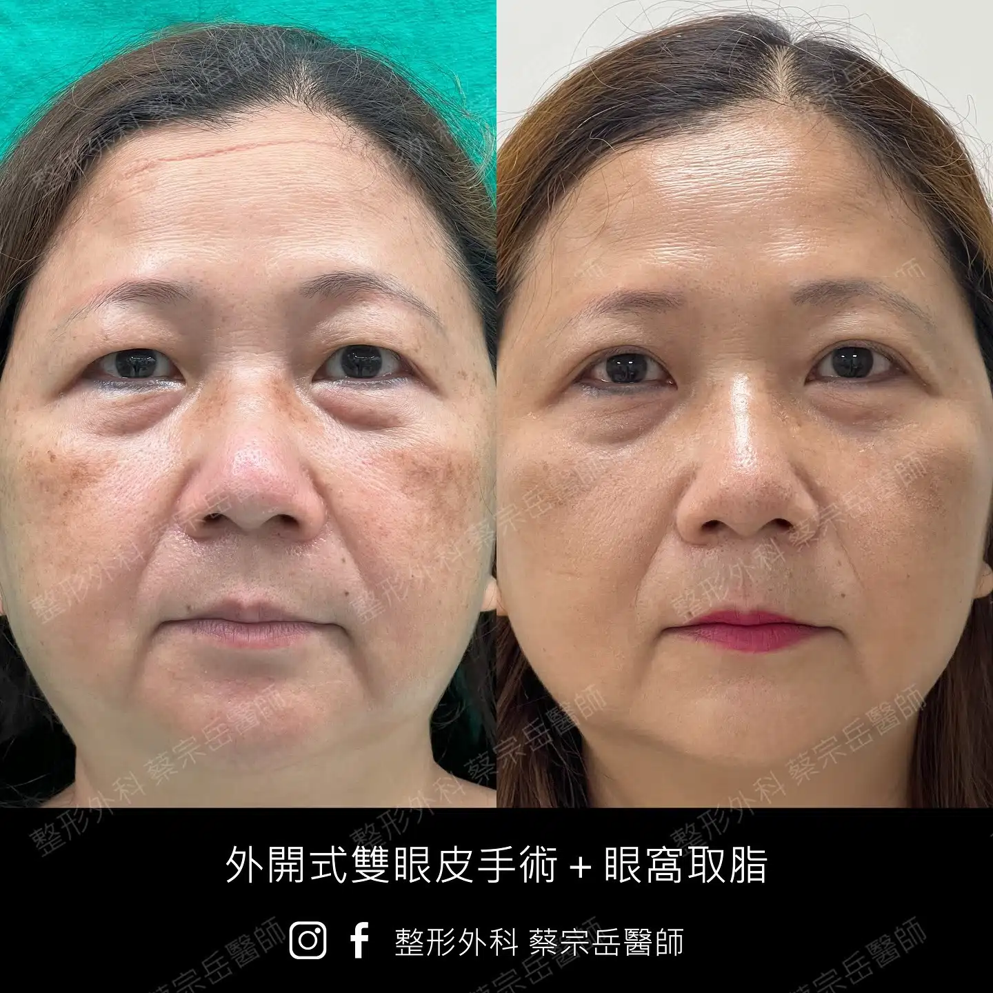 外開式雙眼皮手術+眼窩取脂