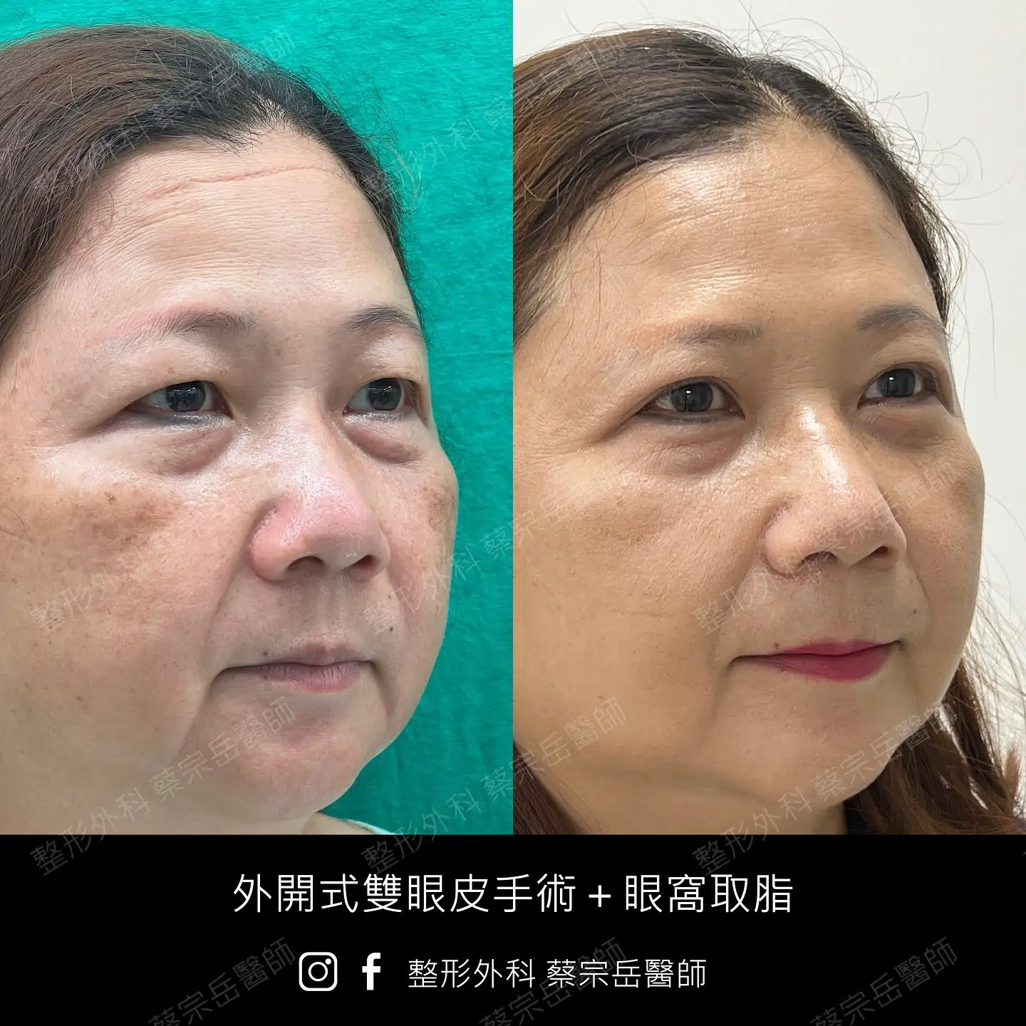 外開式雙眼皮手術+眼窩取脂