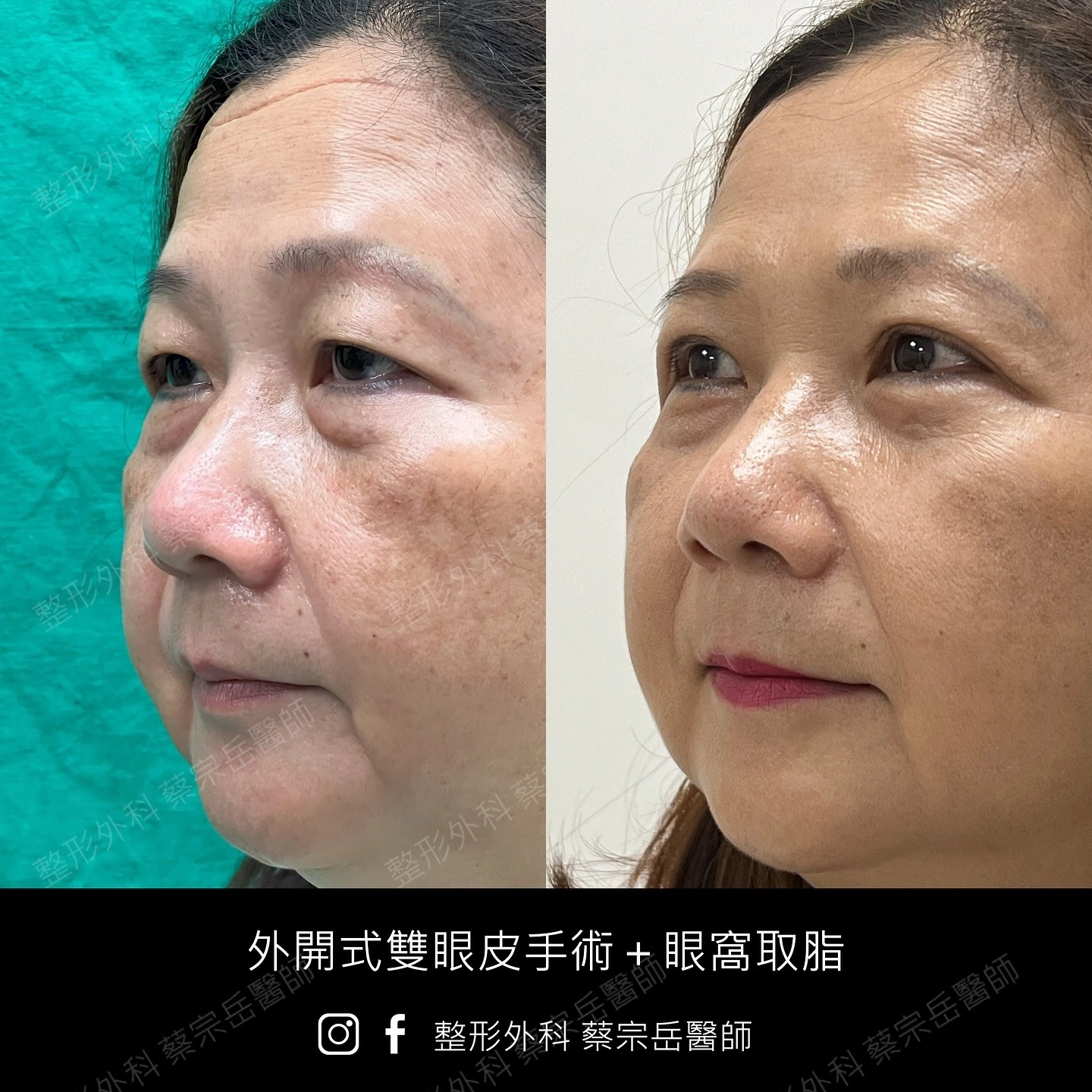 外開式雙眼皮手術+眼窩取脂