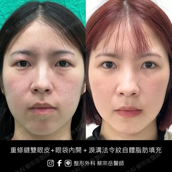 重修縫雙眼皮+眼袋內開+淚溝法令紋自體脂肪填充
