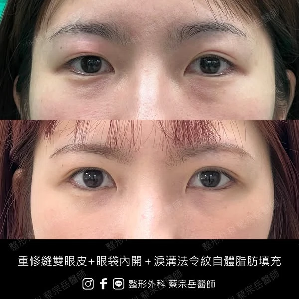 重修縫雙眼皮+眼袋內開+淚溝法令紋自體脂肪填充