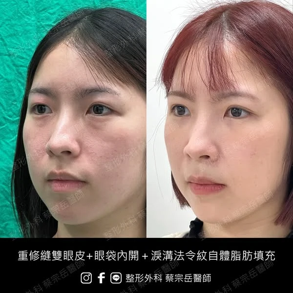 重修縫雙眼皮+眼袋內開+淚溝法令紋自體脂肪填充