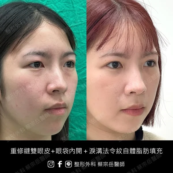 重修縫雙眼皮+眼袋內開+淚溝法令紋自體脂肪填充