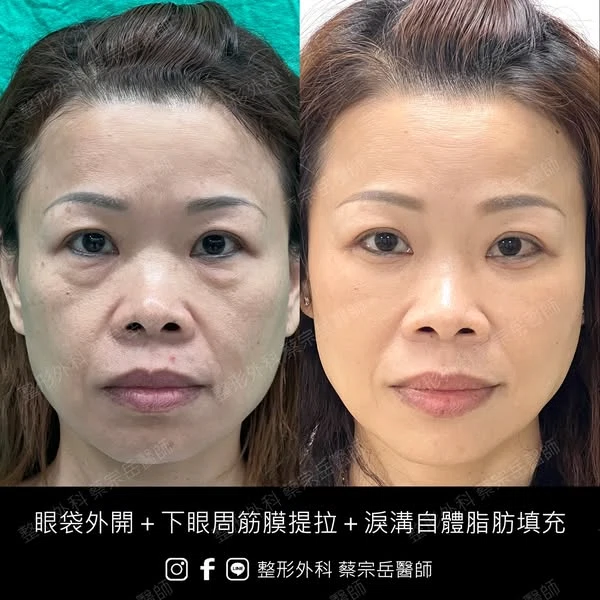 眼袋外開+下眼周筋膜提拉+淚溝自體脂肪填充