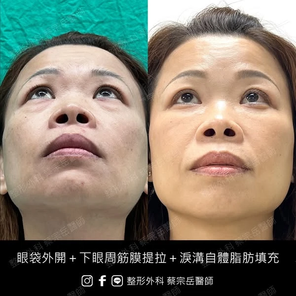 眼袋外開+下眼周筋膜提拉+淚溝自體脂肪填充
