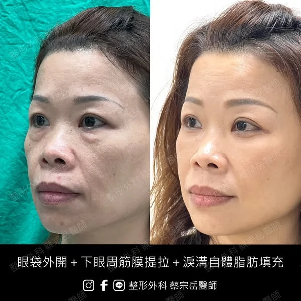 眼袋外開+下眼周筋膜提拉+淚溝自體脂肪填充