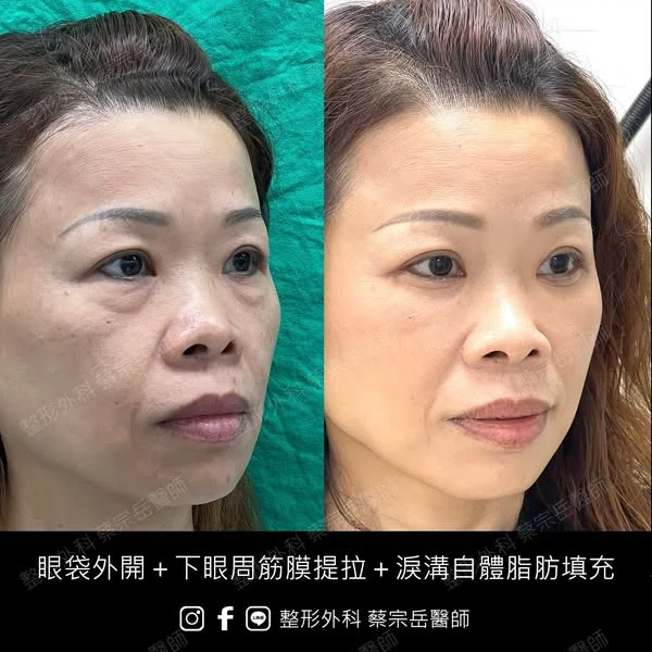 眼袋外開+下眼周筋膜提拉+淚溝自體脂肪填充