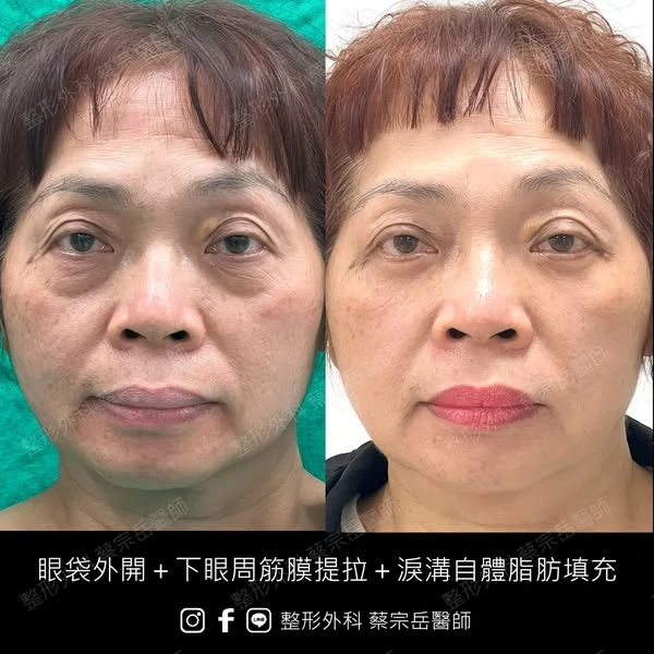 眼袋外開+下眼周筋膜提拉+淚溝自體脂肪填充