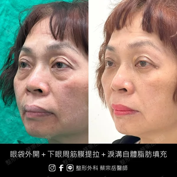 眼袋外開+下眼周筋膜提拉+淚溝自體脂肪填充