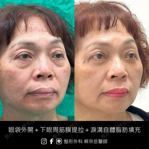 眼袋外開+下眼周筋膜提拉+淚溝自體脂肪填充