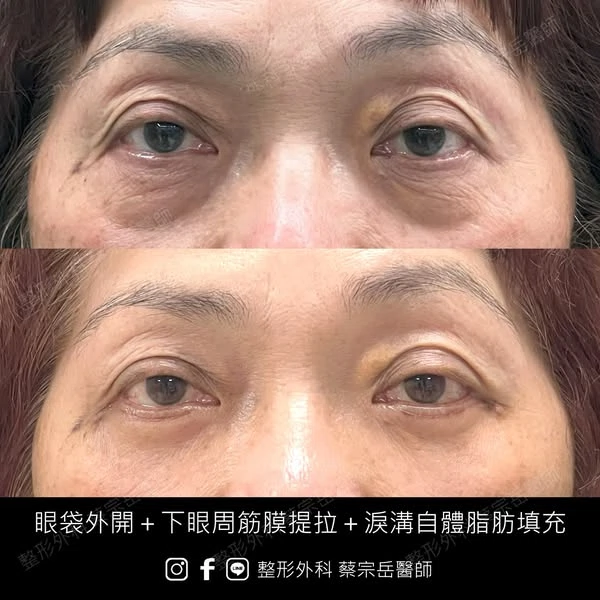 眼袋外開+下眼周筋膜提拉+淚溝自體脂肪填充