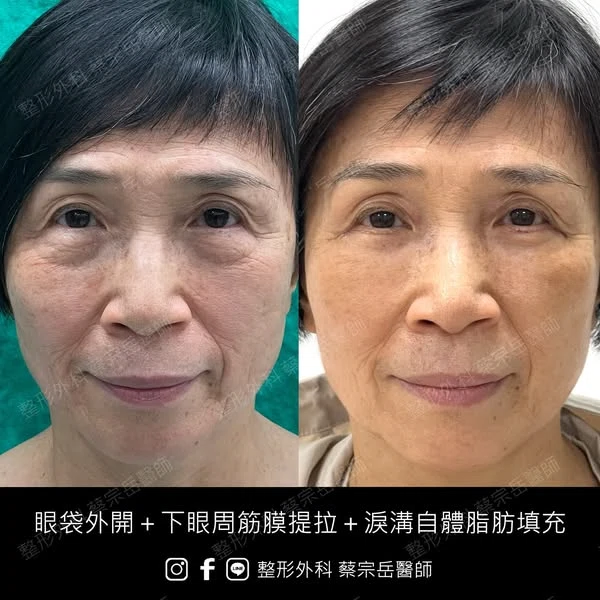 眼袋外開+下眼周筋膜提拉+淚溝自體脂肪填充