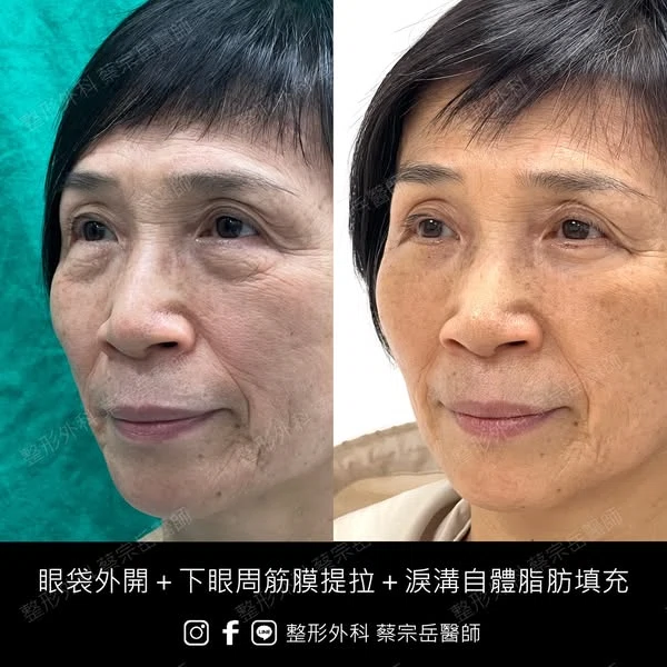 眼袋外開+下眼周筋膜提拉+淚溝自體脂肪填充