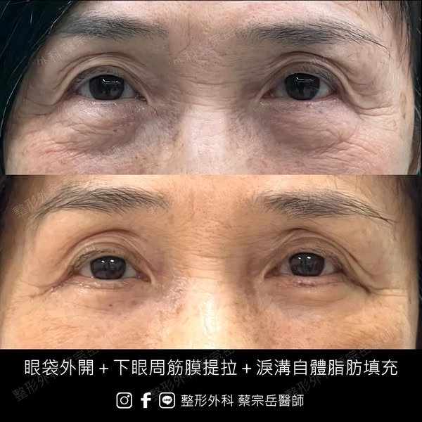 眼袋外開+下眼周筋膜提拉+淚溝自體脂肪填充
