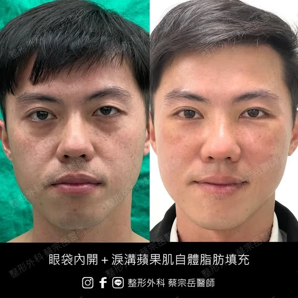 眼袋內開+淚溝蘋果肌自體脂肪填充