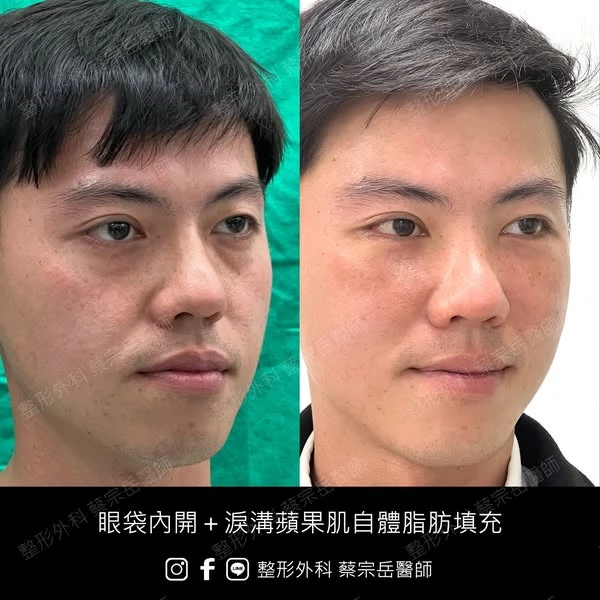 眼袋內開+淚溝蘋果肌自體脂肪填充