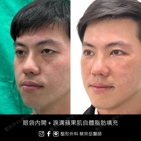 眼袋內開+淚溝蘋果肌自體脂肪填充