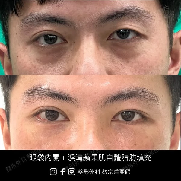 眼袋內開+淚溝蘋果肌自體脂肪填充