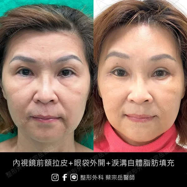 內視鏡前額拉皮+眼袋外開+淚溝自體脂肪填充