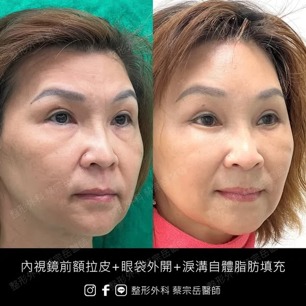 內視鏡前額拉皮+眼袋外開+淚溝自體脂肪填充